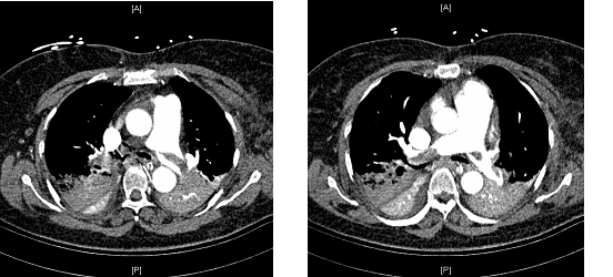 Massive PE Massive PE